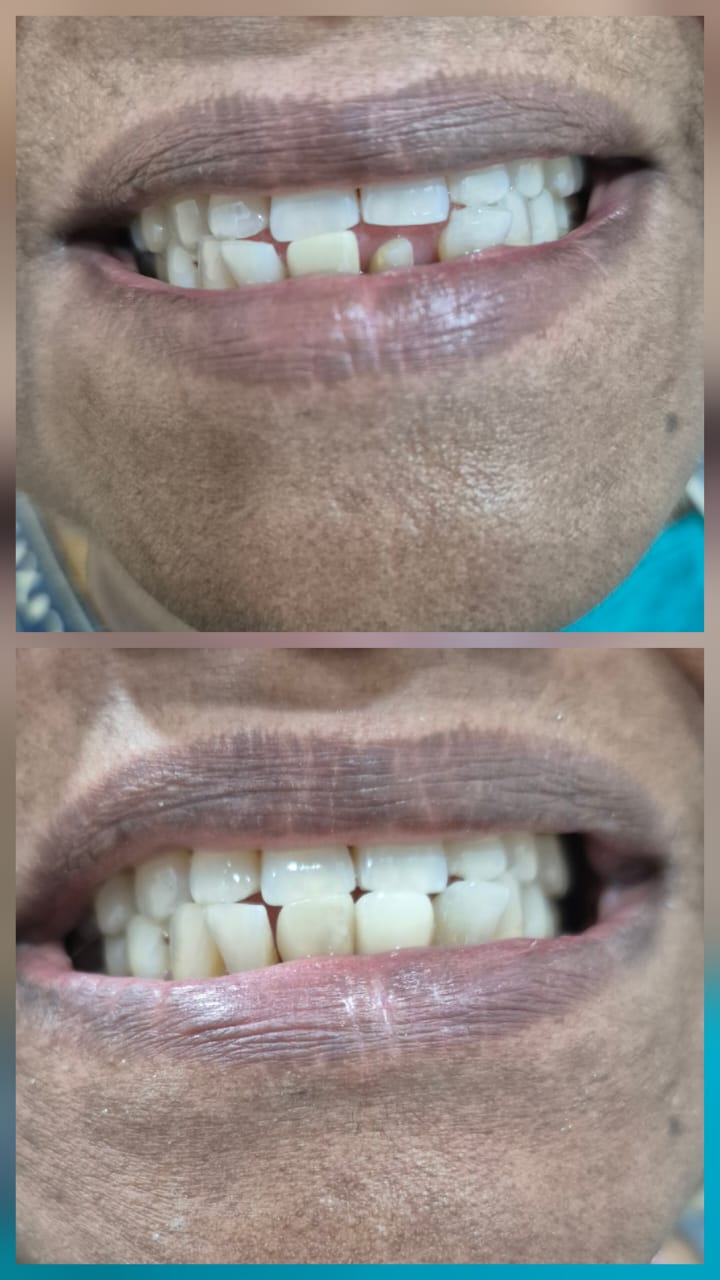 Before and after smile transformation 5